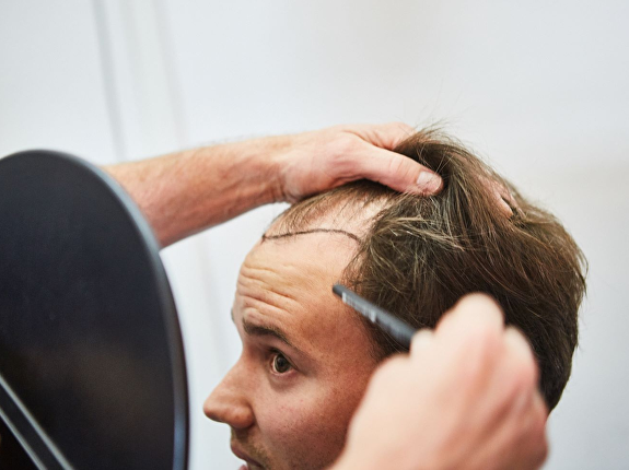 Wat is een FUEplus haartransplantatie?